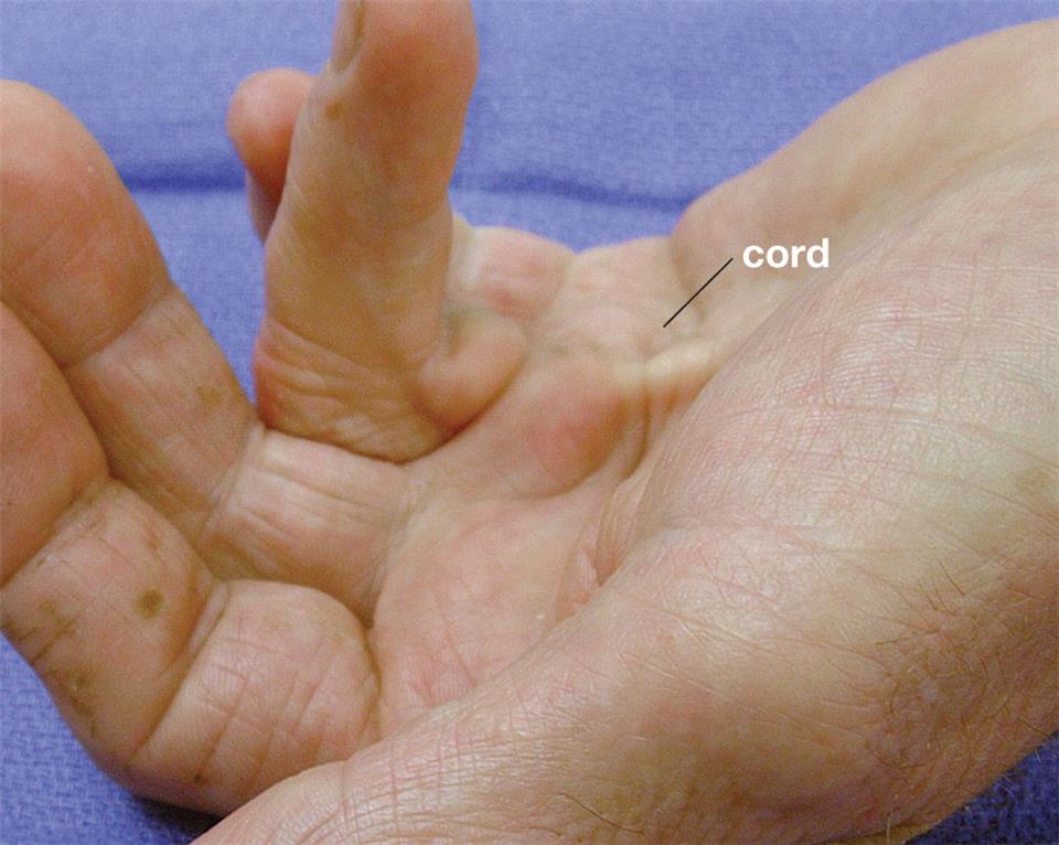 Figures 1 and 2: Advanced case of Dupuytren with pits, nodules and cords leading to bending of the finger into the palm