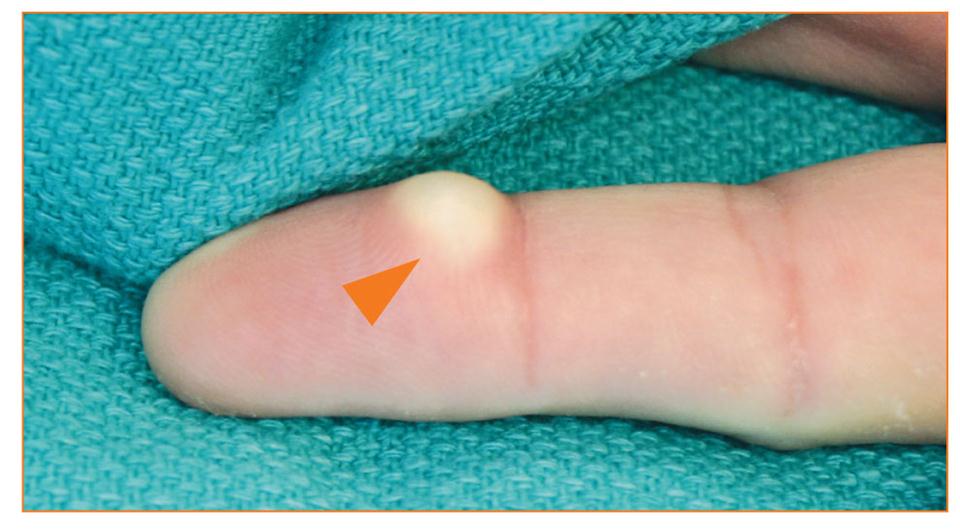 Figure 3: Epidermal inclusion cyst of the finger.
