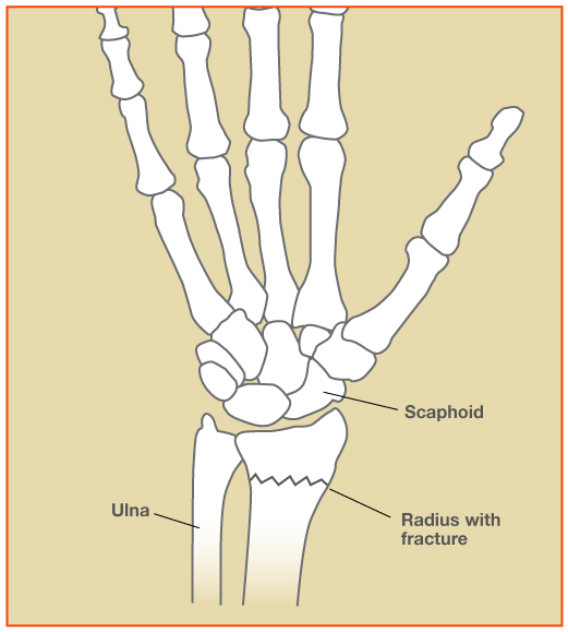 Figure 1:  Wrist bones shown with a non-displaced fracture of the radius.