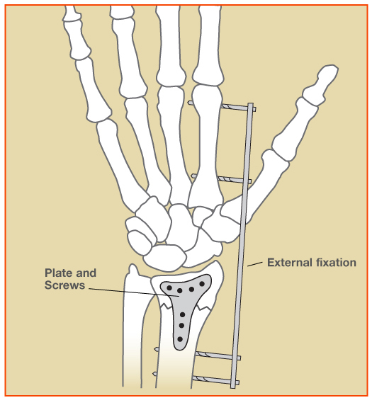 Figure 2:  Radius fracture shown stabilized with external fixation and plate and screws.